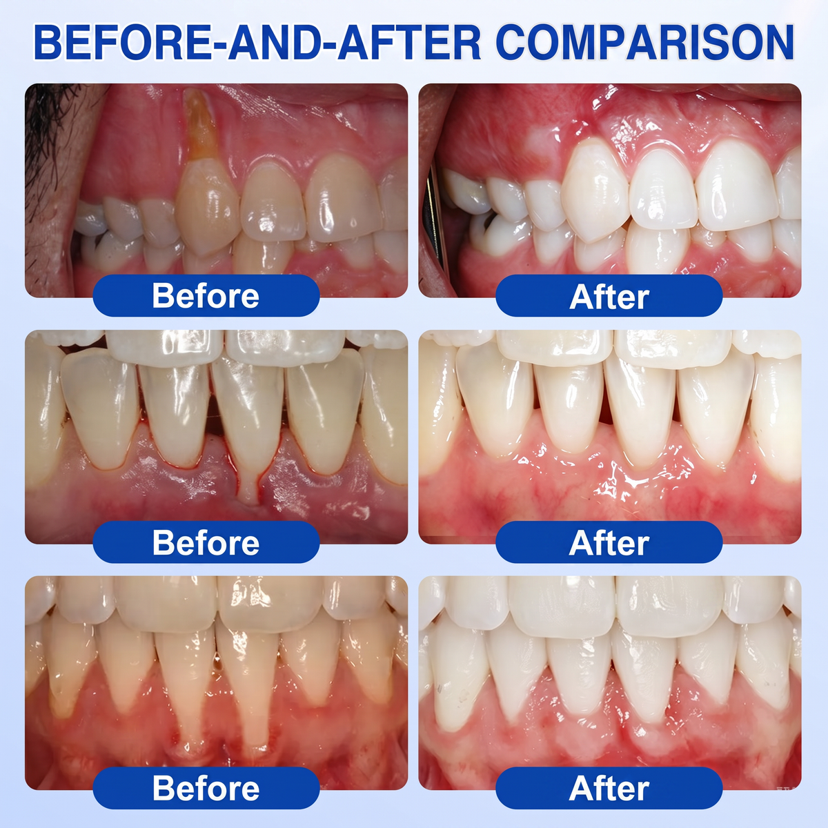 🇬🇧𝐏𝐮𝐫𝐞𝐥𝐨𝐫𝐚® 🦷  periodontal repair gel 🧑‍⚕️
