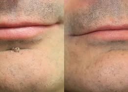 🏥𝐏𝐮𝐫𝐞𝐥𝐨𝐫𝐚®2-in-1 Microneedle & Hydrocolloid Patch🍀| Removes Raised Moles, Acne, Flat Warts & Skin Tags | Helps Improve Wrinkles, Scars & Blemishes | Invisible Patches for Face & Body